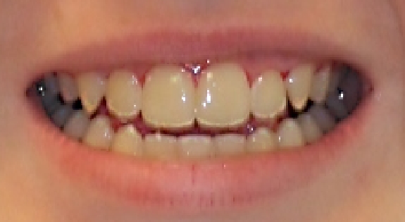 Close up of smile after fixing gapped teeth