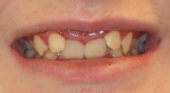 Close up of smile with overcrowded teeth